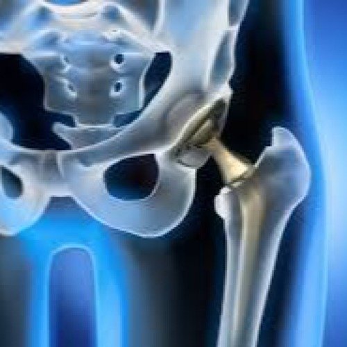 Orthopedic implants